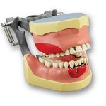 860 Dental Hygiene Periodontal Model with Calculus Teeth and Healthy/Unhealthy Sides